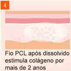 imagem Fio PCL dissolvido estimula colágeno por dois anos