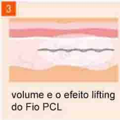 imagem volume e efeito lifting do Fio PCL nos dias seguintes